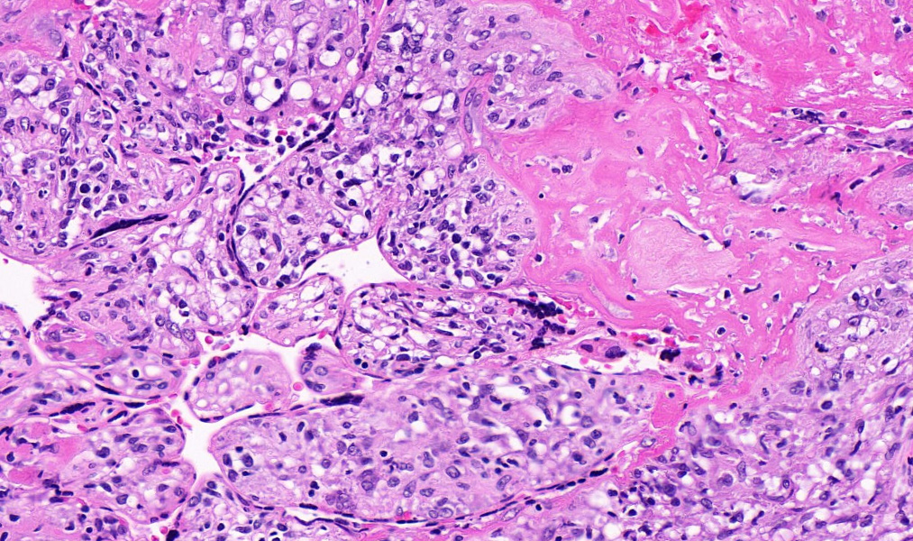 TristanRutland7's tweet image. Placenta

#Gynpath #IDpath #Pathtwitter #pathresidents