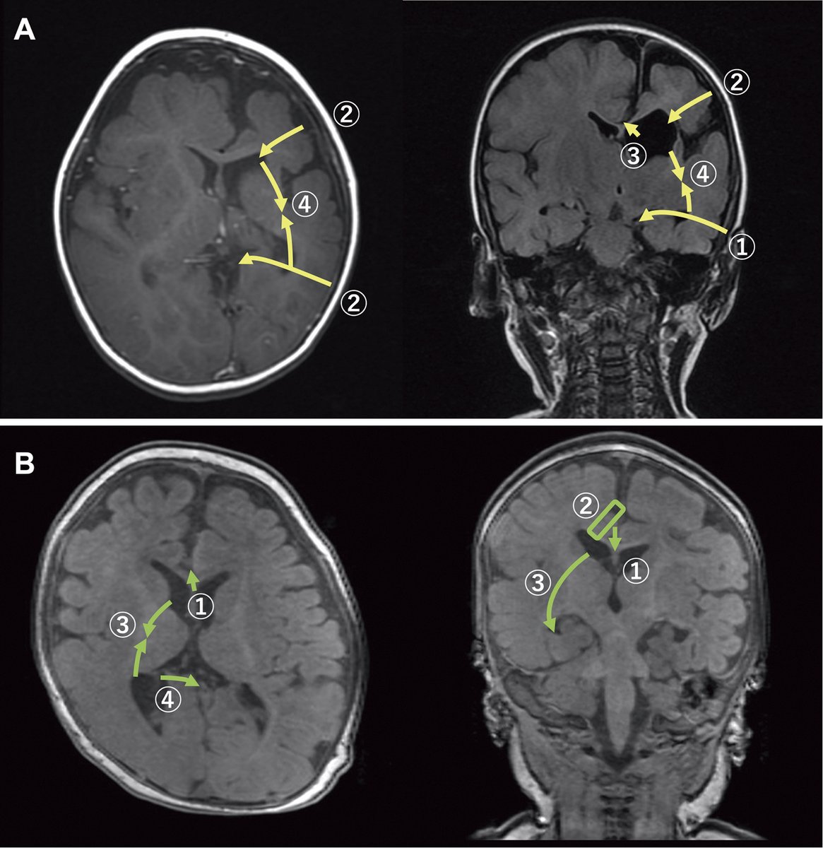 nmc_jns's tweet photo. New Arrival: Surgical Strategy for Hemispherotomy
https://t.co/vivxfXFi1N
#Epilepsy #EpilepsySurgery #FunctionalHemispherectomy #Hemispherotomy #LateralApproach #VerticalApproach
FIRST AUTHOR: Takeshi MATSUO
Department of Neurosurgery, Tokyo Metropolitan Neurological Hospital https://t.co/xd46XeZKeI