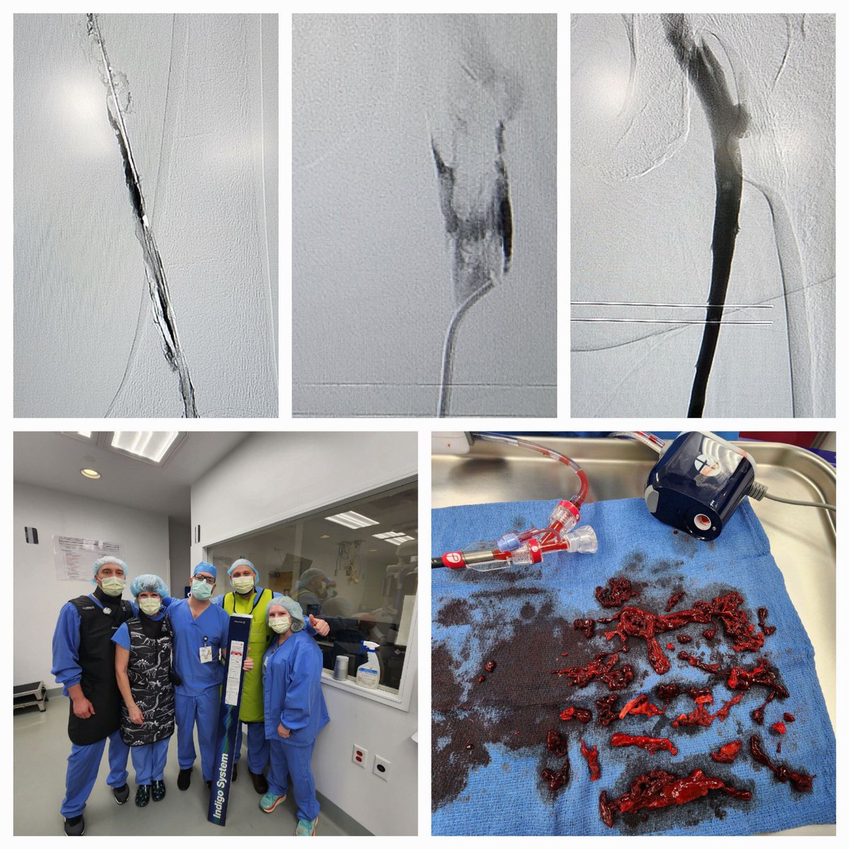 HegewaldMatt's tweet photo. @PenVascular First #LightingFlash case in the WWAMI region! 30 minute procedure time. CAT16 with Lightning Flash mode increased power and decreased EBL. Flash mode attacks and removes more organized thrombus. Pt doing well! #irad https://t.co/S2toYChJMA