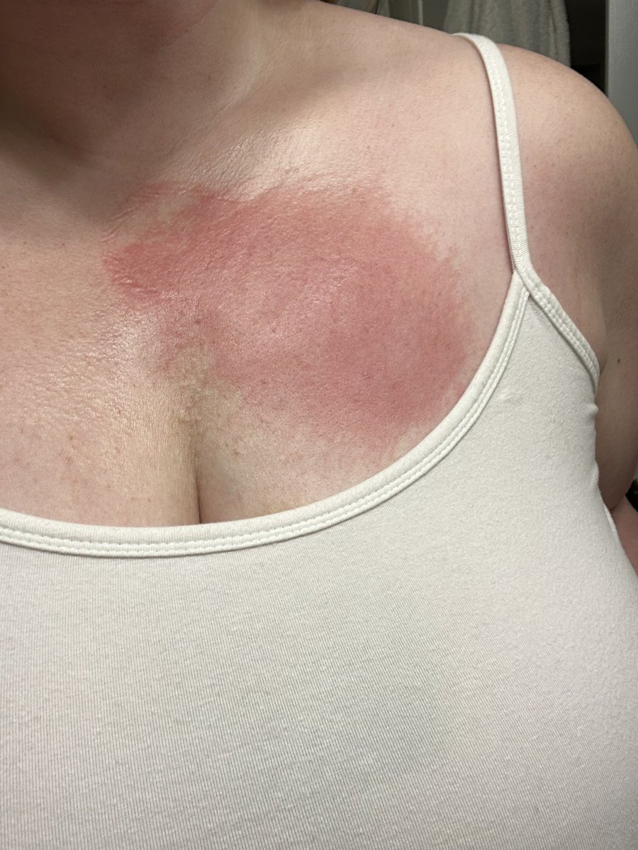 meghals_'s tweet photo. @iRhythmTech I had my monitor installed at 4pm today. By 6:20pm it had fallen off—and now I am left with this burning, red rash. CS told me to remove and send in. What am I supposed to do about the skin discomfort and pain? I don’t even have sensitive skin. https://t.co/EkZgAhz1fu