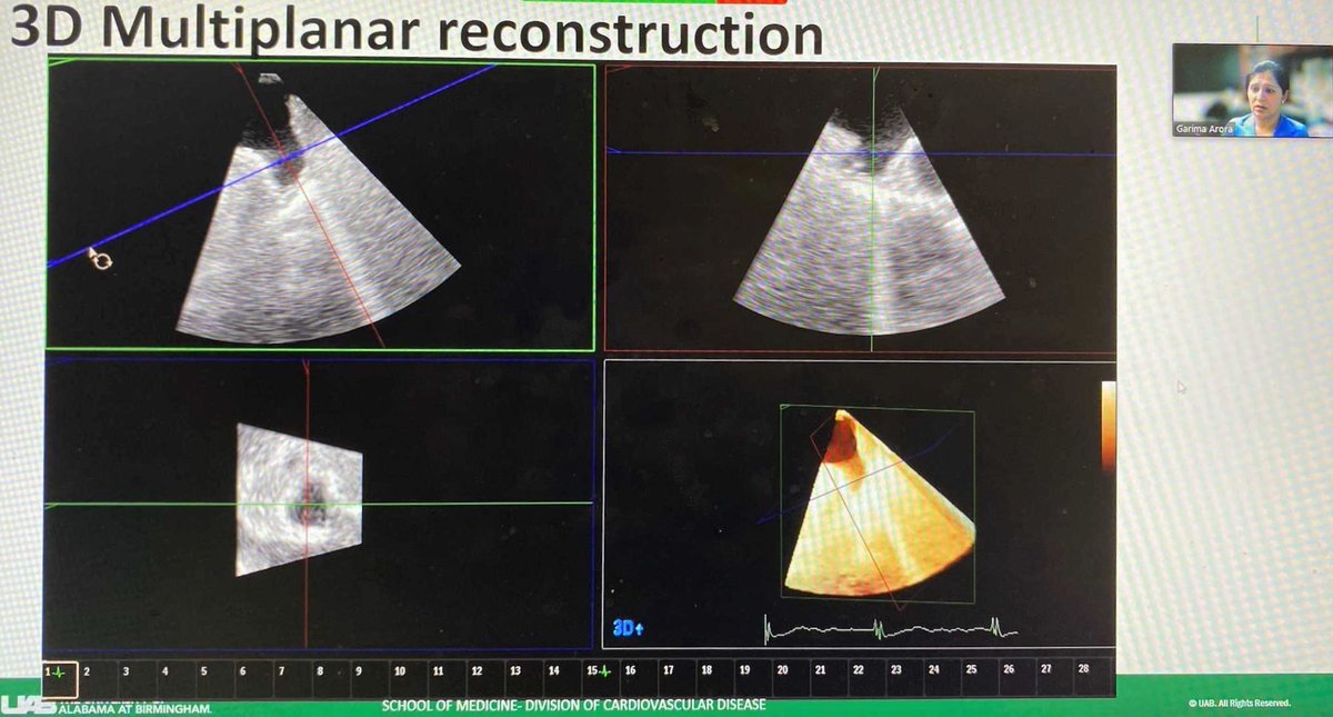 Kudos @GarimaAroraMD on your passion for teaching and for a great talk on the use of 3D TEE for Watchman sizing to Interventional and EP fellows! @NicoleLohrMD @MustafaAhmedMD @UABCardiology @uabmedicine @UABDeptMed @UABCVI @UAB_ECHO