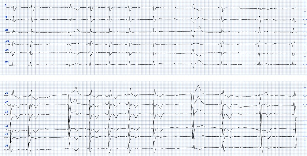 LopezLizarraga_'s tweet image. ¿Qué trastornos de la conducción hay en este ECG?

 #ECG #ECGfirst #ECGChallenge #PMcardio
@JL_MoralesArt @Yldifonso777 @luis_dufour @AngelSotoRod @falsapelirroja @diegocamposfr