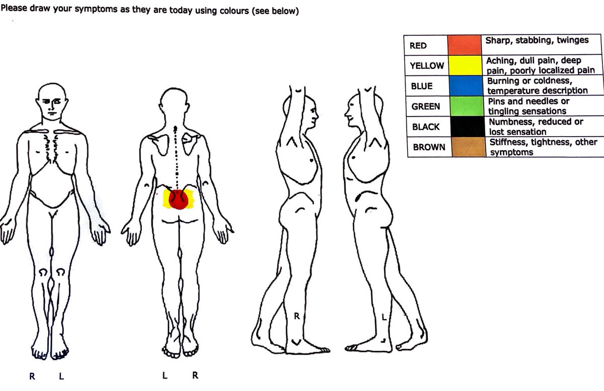 marklaslett_NZ's tweet photo. Is this Chronic NSLBP? 20 yo male. RMDQ 4/24. Pain 9/10 worst, 7/10 Avg, 5/10 best. CSI 6/100 (nil), DASS21 all normal. Pain 2 years persistent/daily worsening. No DP or CP: rep Movt tests NE. SIJ provoc tests all negative. Inflamm screens negative. Waddya reckon? https://t.co/fttegXVdvS