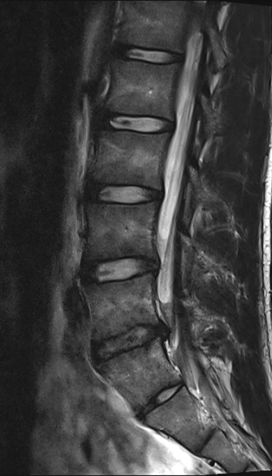 marklaslett_NZ's tweet photo. Is this Chronic NSLBP? 20 yo male. RMDQ 4/24. Pain 9/10 worst, 7/10 Avg, 5/10 best. CSI 6/100 (nil), DASS21 all normal. Pain 2 years persistent/daily worsening. No DP or CP: rep Movt tests NE. SIJ provoc tests all negative. Inflamm screens negative. Waddya reckon? https://t.co/fttegXVdvS