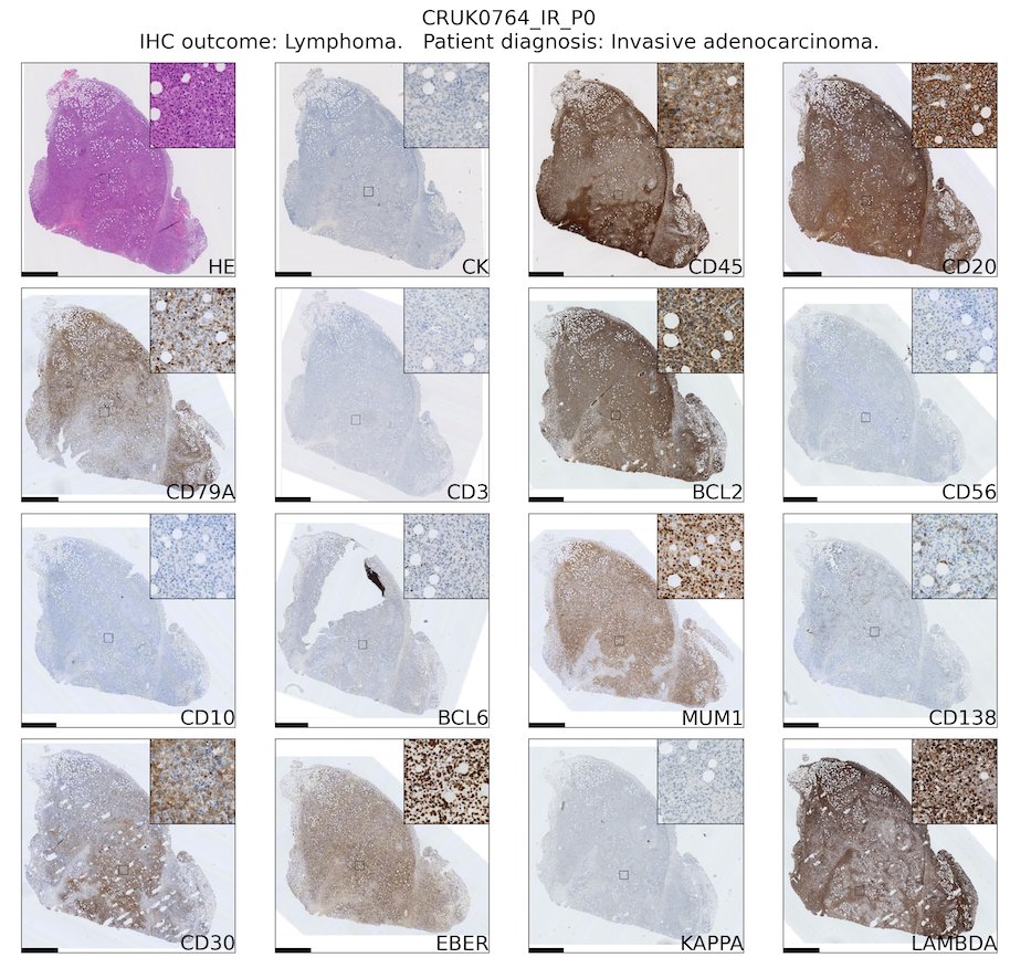 robhynds's tweet photo. In our TRACERx lung cancer patient-derived xenograft (PDX) work, 11% of injections resulted in CD45+ xenografts.
In this companion @biorxivpreprint, led by Dave Pearce, we show that these are EBV+ B lymphoproliferations of human origin... π§΅ (1/5)
https://t.co/LZhp2BHkry https://t.co/nkaysfdNNO