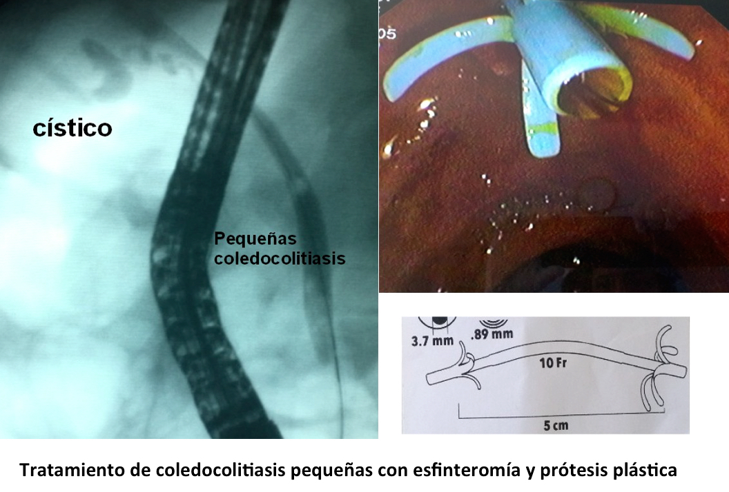 jgarciacano1's tweet photo. Las coledocolitiasis de menos de 5 mm se suelen expulsar espontáneamente, aunque pueden causar colangitis o pancreatitis. Pasar un balón hinchado para extraerlas puede ser traumático para la Papila, a veces preferimos esfinterotomía y prótesis plástica.
https://t.co/pQZHgxgfHr https://t.co/EPZiFuWU7W
