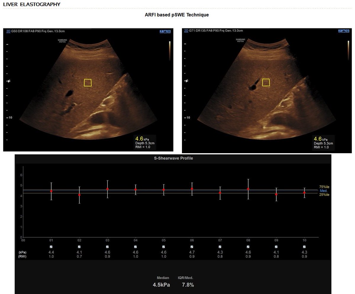ShiviRadiology's tweet photo. #LiverElastography #Ambala 
Liver elastography is a test to measure stiffness of Liver and evaluate fibrosis in it.

ARFI pSWE Technique

Case images by - ⁦@DrAyushGoel⁩ https://t.co/SxXLb0CCtF