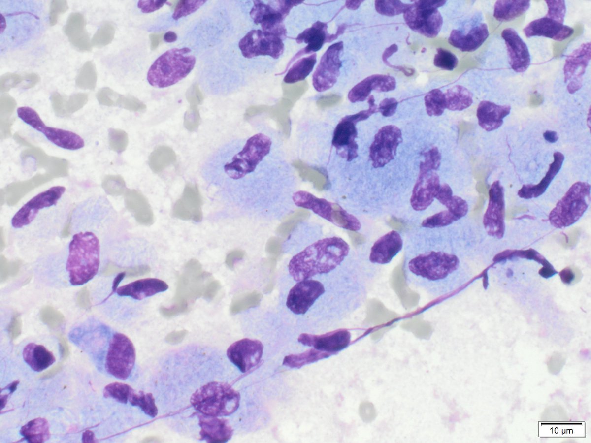 A mediastinal lymph node (adenopathy with no lung mass) for this #FNAFriday.