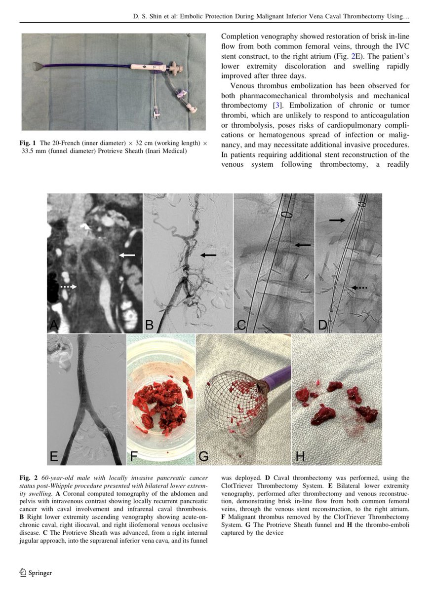 The 20-French (inner diameter) 32-cm (working length) 33.5-mm (funnel diameter) Protrieve Sheath may offer embolic protection during high-risk caval thrombectomy procedures. <a href="/UWRadiology/">UW Radiology</a> <a href="/UofWa_IR/">University of Washington IR Residency</a> <a href="/InariMedical/">Inari, now part of Stryker</a> <a href="/SIRspecialists/">Society of Interventional Radiology</a> <a href="/CVIR_Journal/">CVIR Journal</a> <a href="/VascularNews/">Vascular News</a> <a href="/_backtable/">BackTable Vascular and Interventional</a> <a href="/UWMedicine/">UW Medicine</a>
