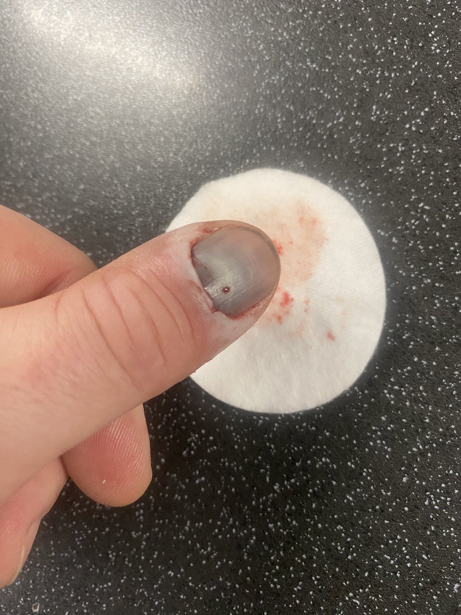 KTMGav's tweet photo. Me and my thumb update. Was a lot more comfortable last night, obviously released a fair bit of pressure. Still seeping a bit of blood this morning, but feels loads better. #meandmythumb #update #homeops #sorethumb https://t.co/R5WnWxjMcp