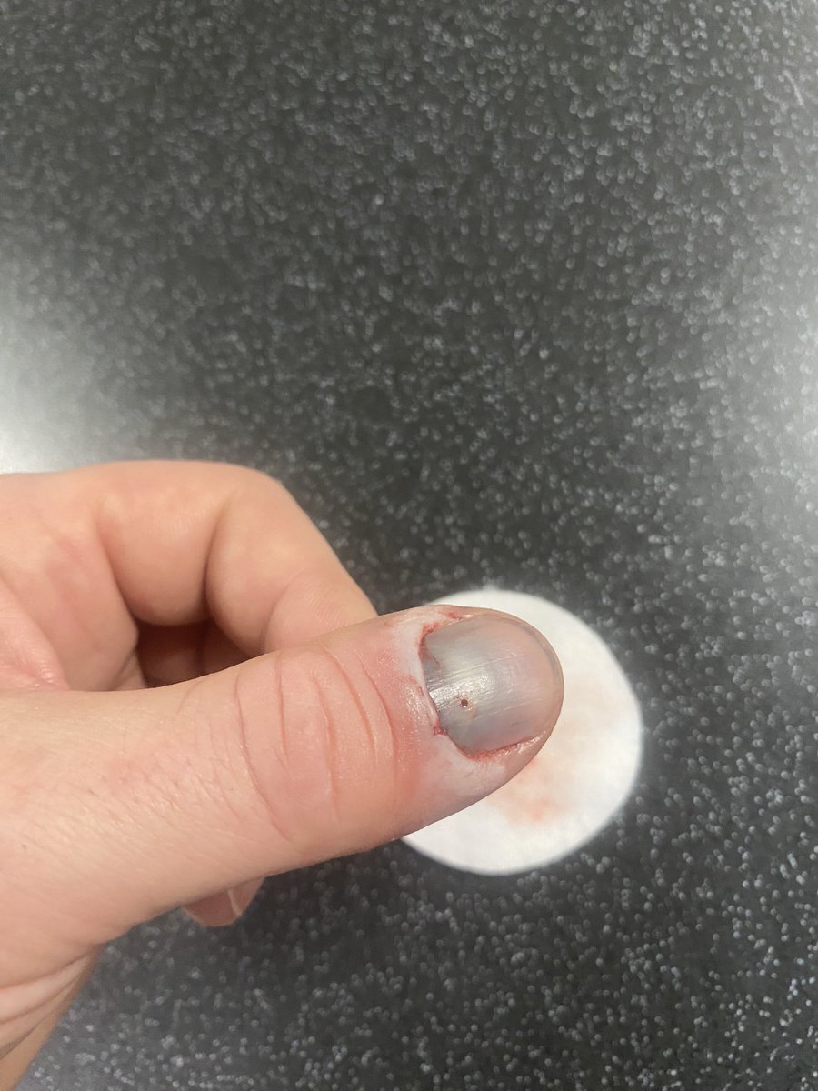 KTMGav's tweet photo. Me and my thumb update. Was a lot more comfortable last night, obviously released a fair bit of pressure. Still seeping a bit of blood this morning, but feels loads better. #meandmythumb #update #homeops #sorethumb https://t.co/R5WnWxjMcp