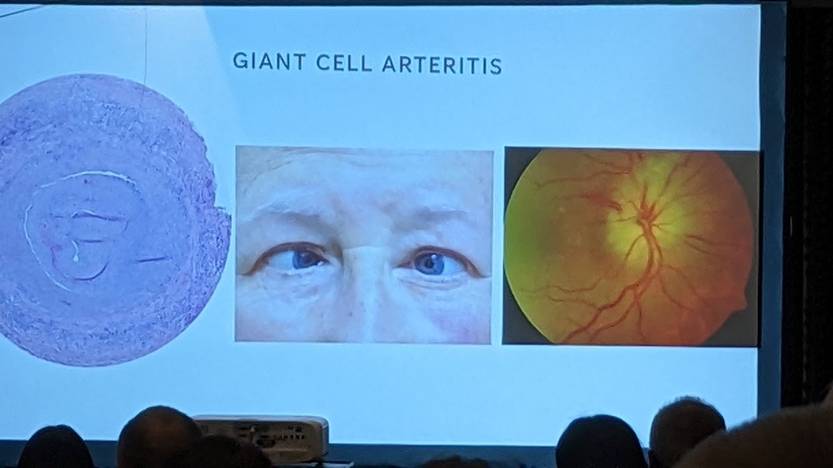 Brilliant presentation by <a href="/DrMollan/">Dr Susan Mollan</a> this morning <a href="/UK_headache/">BASH</a> on eye masquerades in headache clinic: act fast if suspicions of GCA, transient double vision, can be early sign