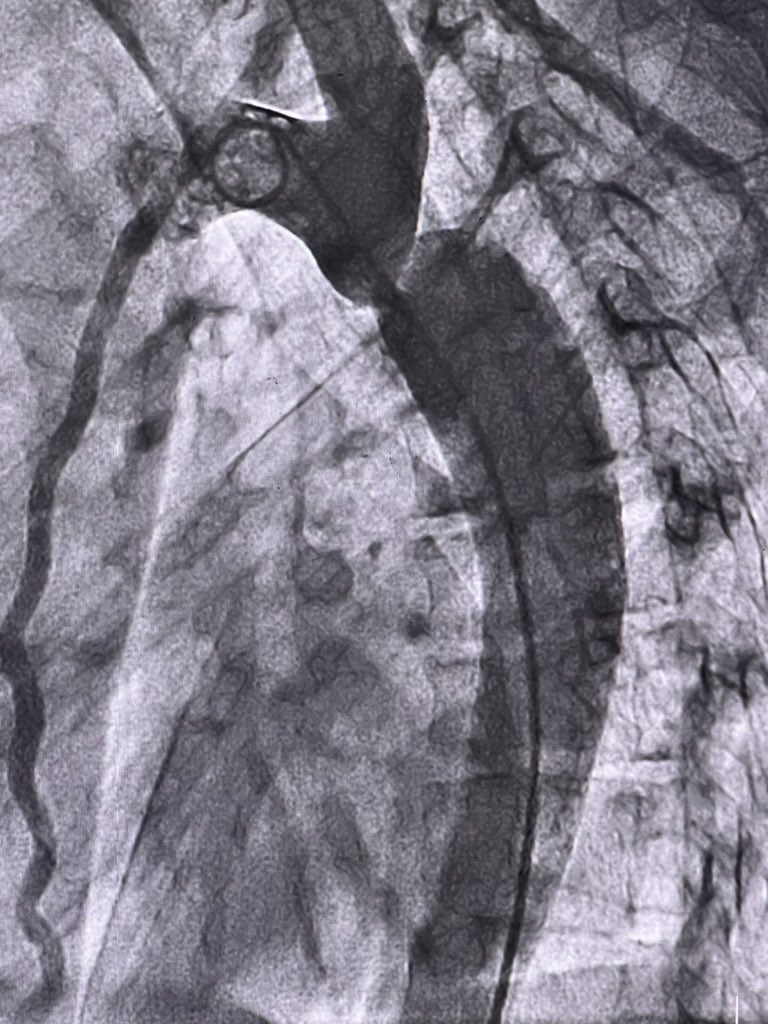 drsalikmemon's tweet image. Great learning cases today. Successful COA stenting….Thanks to my mentors #Interventionalfellow #NICVD.