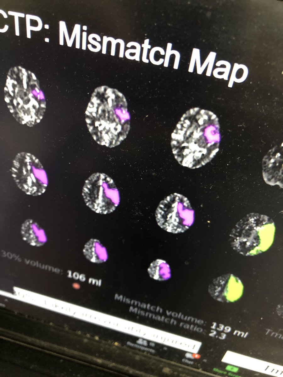 keeling_michael's tweet photo. Learning about #RapidAI
It’s implementation @YSTeachingNHS is going to really help our acute stroke management for our patients 😊
#stroke #acutestroke #thrombectomy #NOSIP #DIDO #radiology https://t.co/8VyBuZNDNR