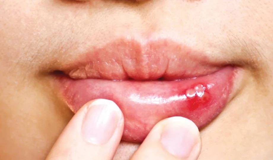 DoktorSamhan's tweet photo. 9 FAKTA TENTANG ULSER MULUT

1. Ulser mulut juga dikenali sebagai serawan, guam, atau “mata ikan” ini adalah luka pada mukosa mulut.Biasanya terjadi pada bahagian dalam bibir, dalam pipi dan juga di permukaan lidah. https://t.co/VjVPbFR49S