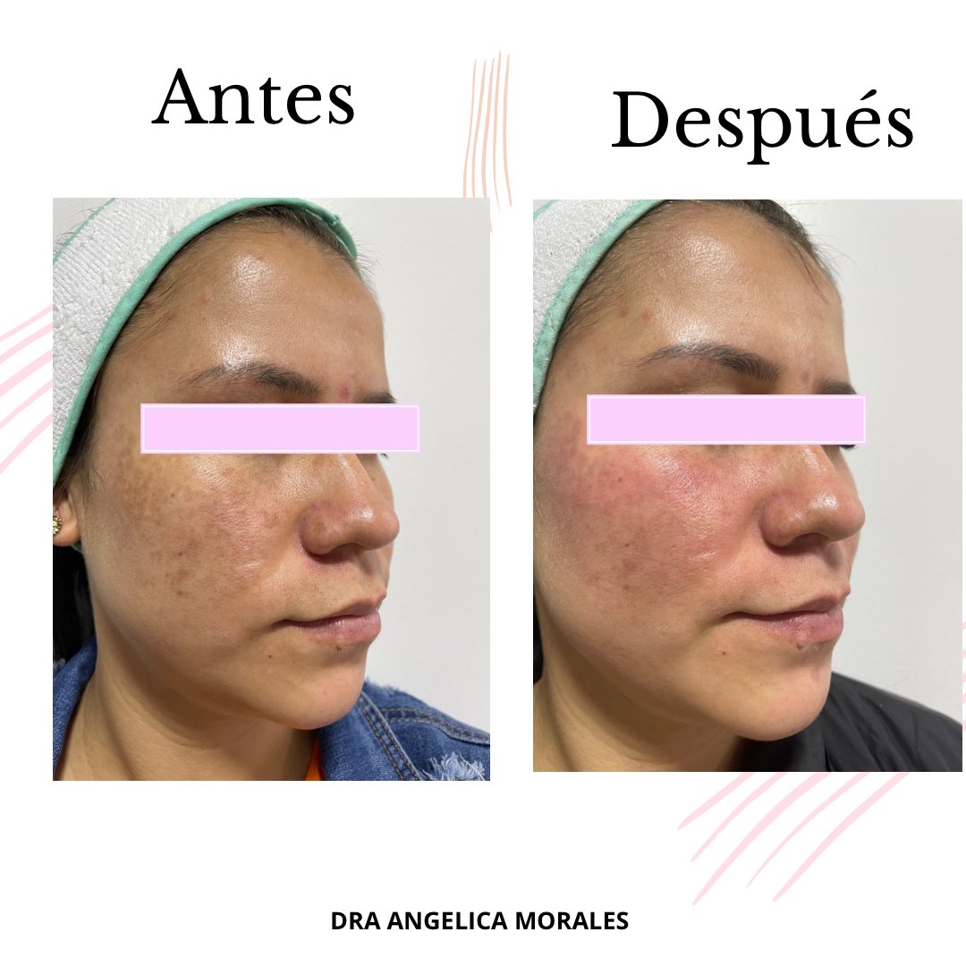 AngelicaMaMoMa's tweet photo. Con el tratamiento adecuado y la disciplina del tratamiento en casa podemos en poco tiempo tener cambios importantes en nuestras manchas! Consulta tu dermatologa 🤍👩‍⚕️

#skincare #dermatologia
#medicalcare
#skin #facial
#skincaretips
#dermatips #cuidadodelapiel #dermatologa https://t.co/LJ9Qg0sG4o