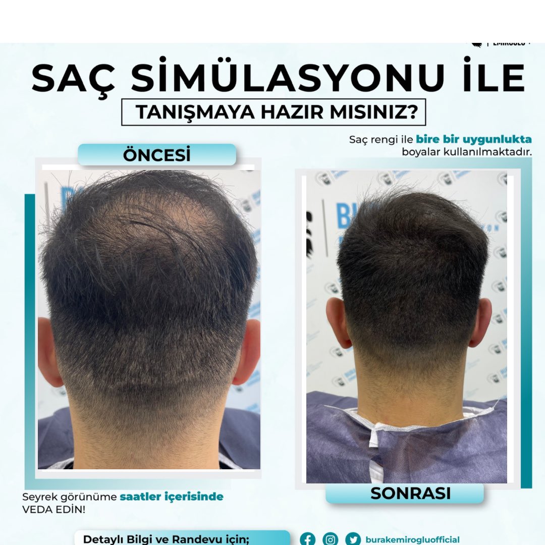 Saç Simülasyon Merkezi Burak Emiroğlu

Saatler içerisinde saçınızın seyrekliğine son veriyoruz.

Detaylı bilgi İçin 
Ofis 0212 288 61 26 Whatsapp 0533 643 61 26

#scalp #scalpmicropigmentiton #saç #hairtransplantation #saçsimülasyon