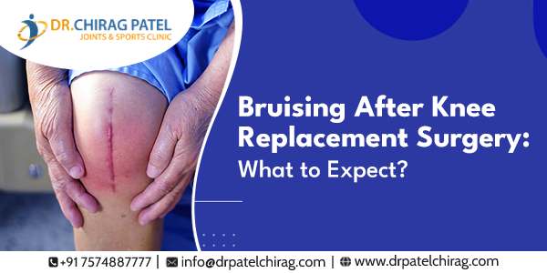 The body does take its time to heal and adapt to the new joint. Pain and bruising are common symptoms that develop during this adaptation process.
drpatelchirag.com/blog/bruising-…
#drchiragpatel #mumbaidoctors #orthopaedicdoctor