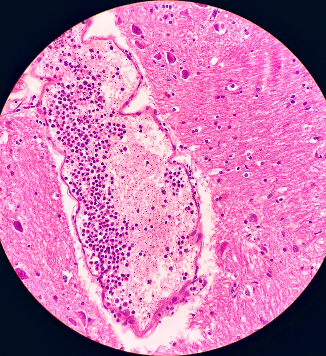 Today’s daily routine was not routine at all🙀Section from the brain stem of a middle-aged man. I will reveal the history later, just curious who will see the pathology first. Any ideas?
#PathTwitter #neuropath #autopsy #MedTwitter #forensicpath #crittersontwitter
@CraigHorbinski