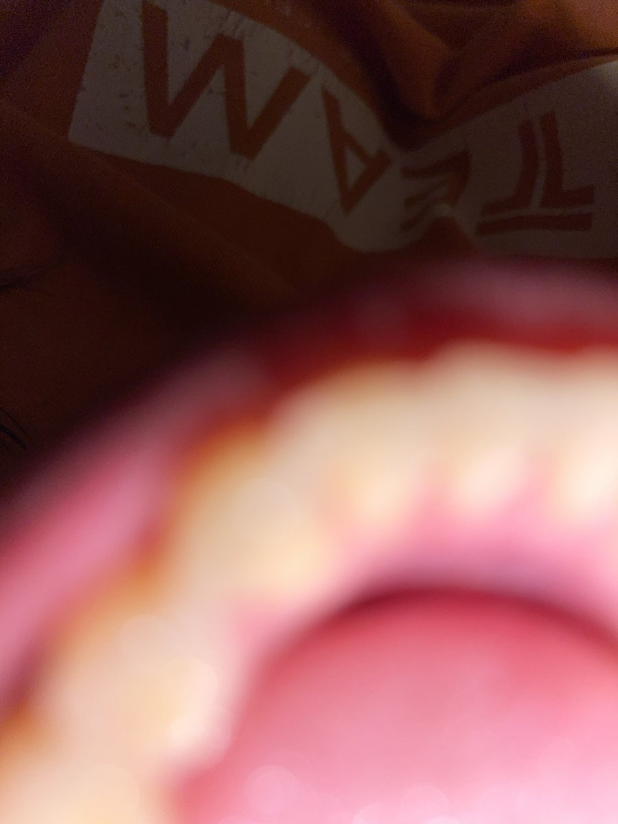 MammaGene's tweet photo. Me last night trying to take a picture of the inside of my mouth instead of going to the dentist like a normal person https://t.co/i2Y7KjPWRt