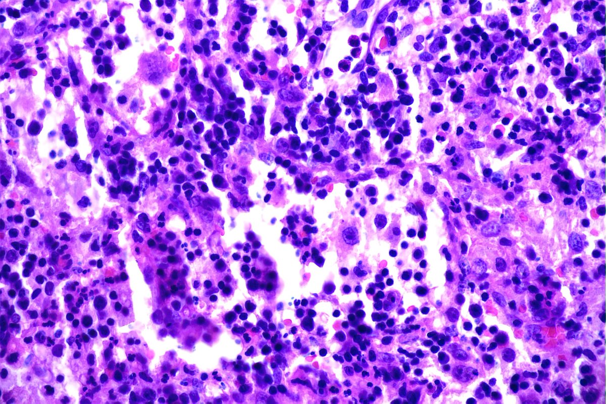 GeronimoJrLapac's tweet photo. 2-year-old child with cervical lymphadenopathy. Diagnosis and Marker?
#pathplus #pathology #hemapath https://t.co/oScDtJRw7q