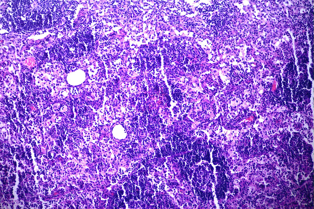GeronimoJrLapac's tweet photo. 2-year-old child with cervical lymphadenopathy. Diagnosis and Marker?
#pathplus #pathology #hemapath https://t.co/oScDtJRw7q