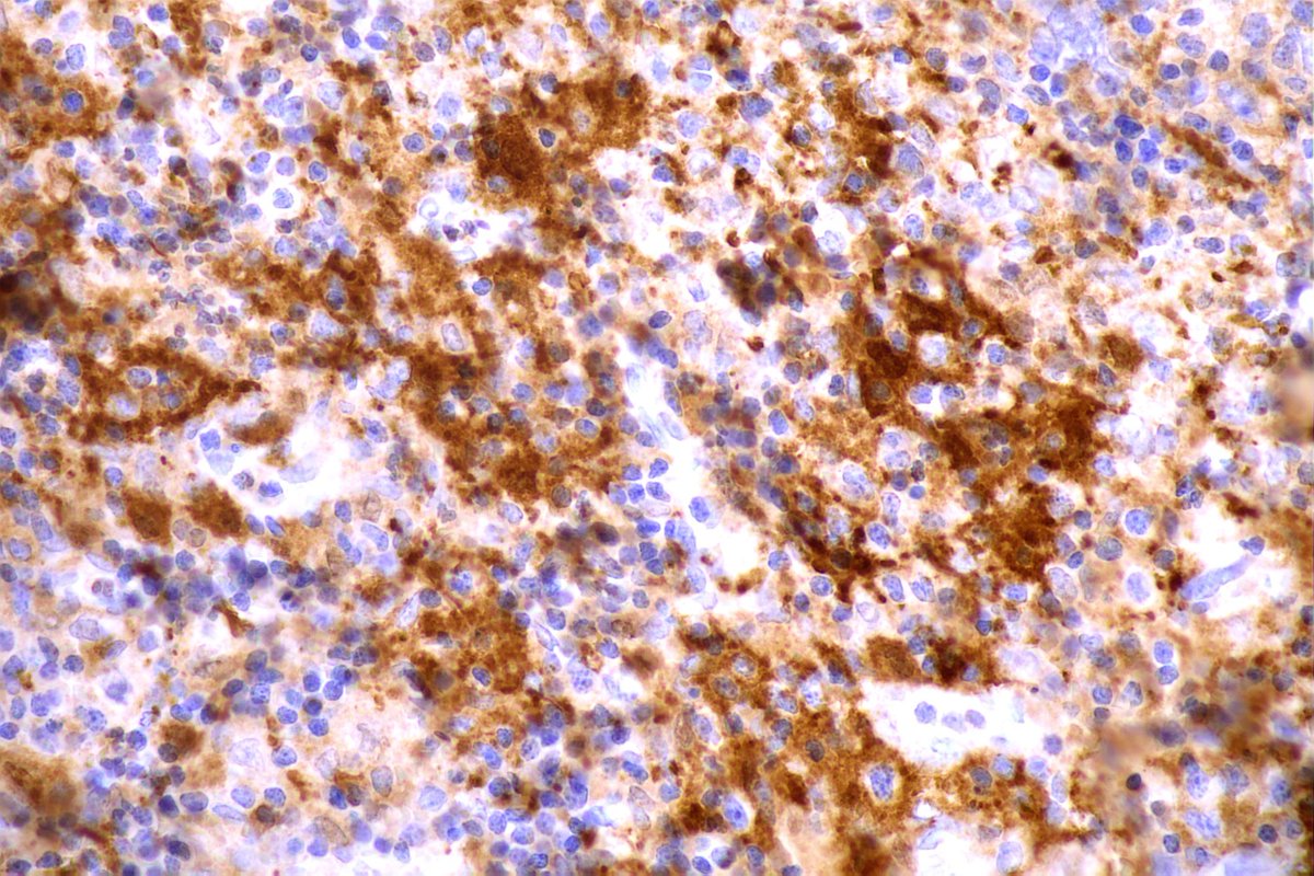 GeronimoJrLapac's tweet photo. 2-year-old child with cervical lymphadenopathy. Diagnosis and Marker?
#pathplus #pathology #hemapath https://t.co/oScDtJRw7q