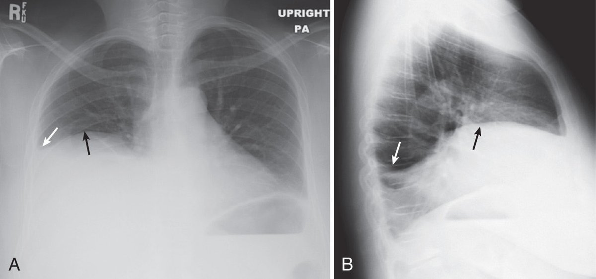 jemiliolive's tweet photo. 🆘 Cuándo usar albúmina en pacientes con cirrosis❓
Una guía rápida para no perderse en el camino y evitar efectos adversos relacionados con su administración.

#LiverTwitter #tweetorial

Imagen de: William Herring MD, FACR. Learning Radiology: Recognizing the Basics, 8, 60-69 https://t.co/91bOcKZinb