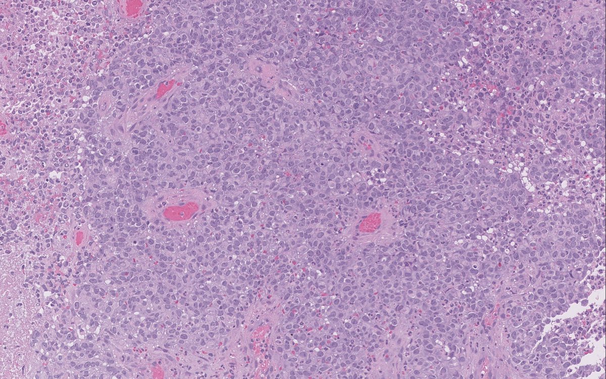 Twitter me this…

🔹Large sinonasal mass. 

🔹H&amp;Es attached.