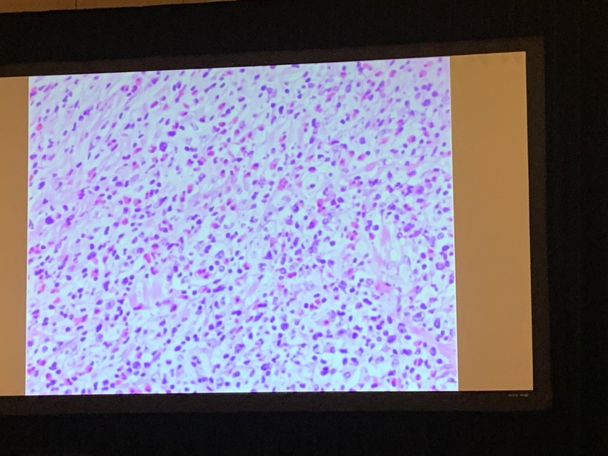 TexPathol's tweet image. Enteropathy associated T cell lymphoma ⁦@ScottOwensPath⁩ ⁦@lbsmithmd⁩ #Texpathol #TSP2023AM