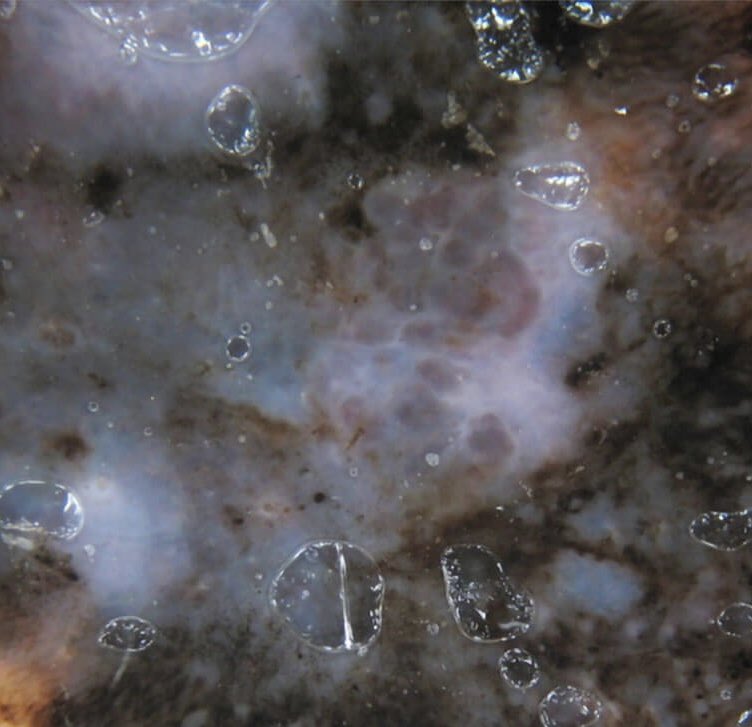 thatdermguy's tweet photo. It may look like you’re gazing at a picture of a galaxy across the universe, but in fact this is a close up of a deadly skin cancer known as Melanoma, where the pigment cells grow uncontrollably. #CheckYourMoles https://t.co/VmsJpowoSL