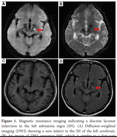 AN_ASP_'s tweet image. Choreoathetosis of the upper limb with #contralateral substantia nigra lacunar infarction: A case report and literature review
Authors: Mengxin Li, Xiaojun Zhang, Yanqiang Wang
#Substantianigra #Dancelikemovements #Ischemicstroke 
Read more: 👇 
accscience.com/journal/AN/2/1…