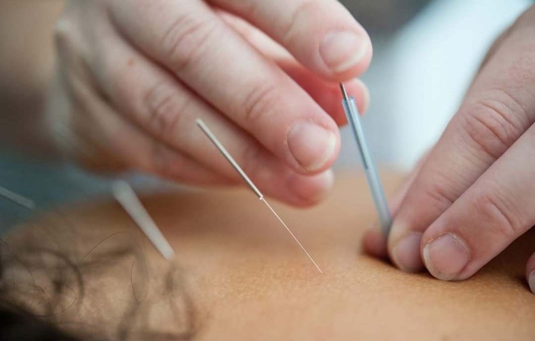 What is medical acupuncture?
amac.org.au

We offer our patients medical acupuncture performed by a licensed and highly experienced general practitioner trained in western medicine and further trained in acupuncture as a specialty practice.

#medicalacupuncture