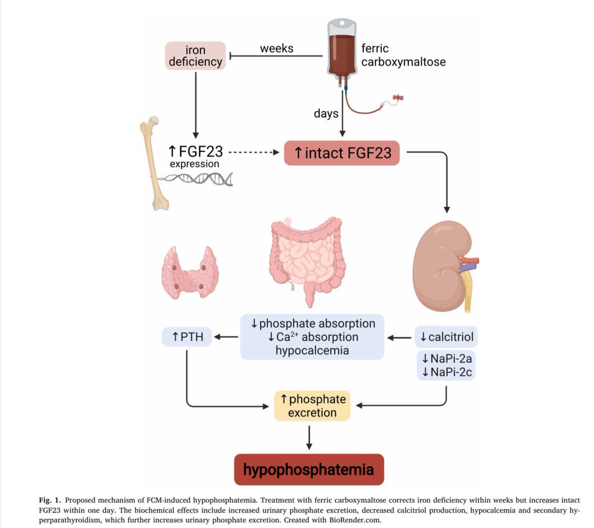 IV iron-ferric carboxymaltose, ferric derisomaltose both can cause severe #hypophosphatemia. Recently happened to my patient with #fanconi. Well described now in literature. tinyurl.com/bdhchhxh Mechanism👇#Anemia #NephTwitter #MedTwitter #HemeTwitter