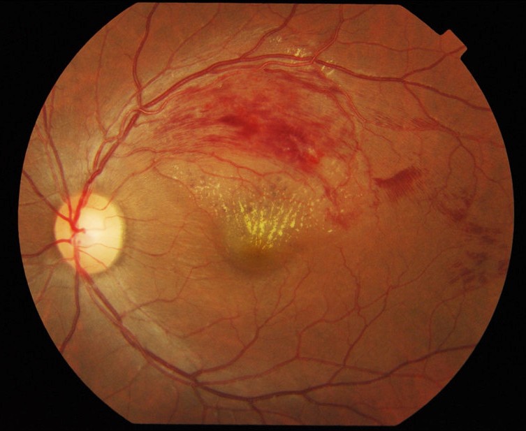 RetinaGlobal1's tweet image. In a paper in @SciReports from #Japan, individualized treatment protocol with #Eylea (#aflibercept) that was based on the period of efficacy in treatment-naïve #BRVO eyes with macular edema was found to achieve satisfactory long-term visual outcome.