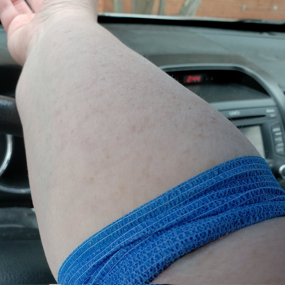 I had my Saphnelo infusion today & also had to get a blood draw. The MA & the phlebotomist respectively chose these bandages for me. I told them with my pale pale skin they made me a trans flag, which is really cool. 🏳️‍⚧️