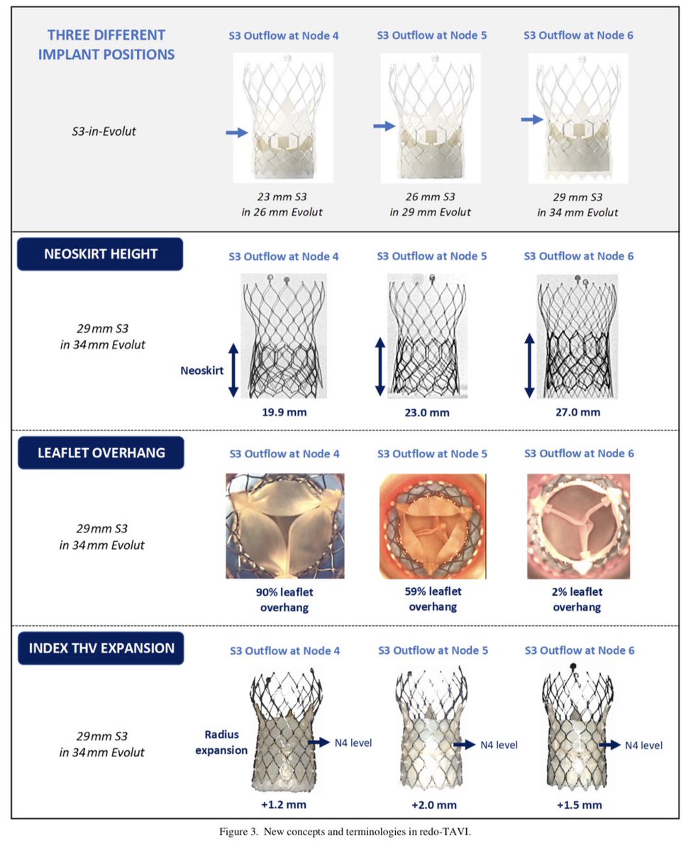 REDO TAVI requires specific competence and knowledge of new concepts and terminology.
Our paper with <a href="/G_Tarantini01/">Giuseppe_Tarantini</a> <a href="/parma/">Radoslaw Parma</a> <a href="/VDelgadoGarcia/">Victoria Delgado</a> <a href="/J_Sathananthan/">Janar Sathananthan</a> O. de Backer, H. Treede, D. Blackman

#redoTAVI #redoTAVR #TAVinTAV #THVinTHV 

authors.elsevier.com/sd/article/S00…