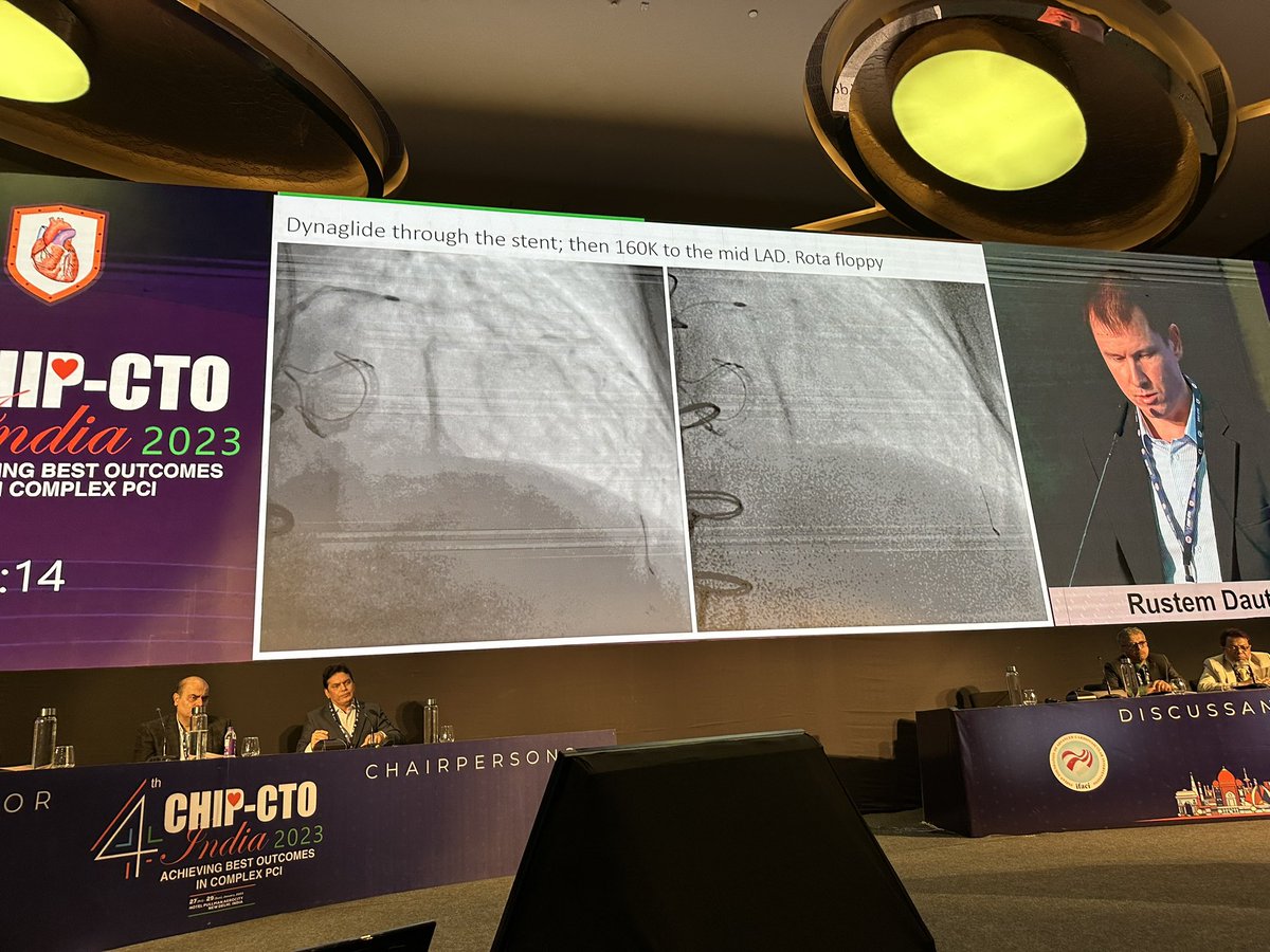 mmamas1973's tweet photo. @dautov_MD #chipcto rotablation through previously deployed LAD stent with stuck burr and stent embolectomy ๐ณ great case- learning point, protect your fresh stent with guide extension when rotablating @Dr_AshokSeth @jcspratt @mirvatalasnag @LAzzaliniMD @NishithChandra https://t.co/lDtDyWqwYg