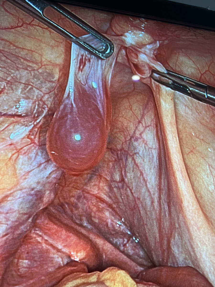 Jose M. Balibrea MD, PhD, FACS (@balibreajose) on Twitter photo What does this image of a "false incarcerated hernia" unmasked by the TAPP approach correspond to?
#SoMe4Surgery <a href="/juliomayol/">Julio Mayol</a> <a href="/ManuelLpezCano1/">Manuel López Cano</a> <a href="/MarcosBruna_/">Marcos Bruna</a> <a href="/AecPared/">Seccion Pared AEC</a> <a href="/aecirujanos/">aecirujanos</a> <a href="/EnricoMarrano/">Enrico Marrano, MD</a> <a href="/AQGimbernat/">Gimbernat Surgical Society</a> What does this image of a "false incarcerated hernia" unmasked by the TAPP approach correspond to?
#SoMe4Surgery <a href="/juliomayol/">Julio Mayol</a> <a href="/ManuelLpezCano1/">Manuel López Cano</a> <a href="/MarcosBruna_/">Marcos Bruna</a> <a href="/AecPared/">Seccion Pared AEC</a> <a href="/aecirujanos/">aecirujanos</a> <a href="/EnricoMarrano/">Enrico Marrano, MD</a> <a href="/AQGimbernat/">Gimbernat Surgical Society</a>