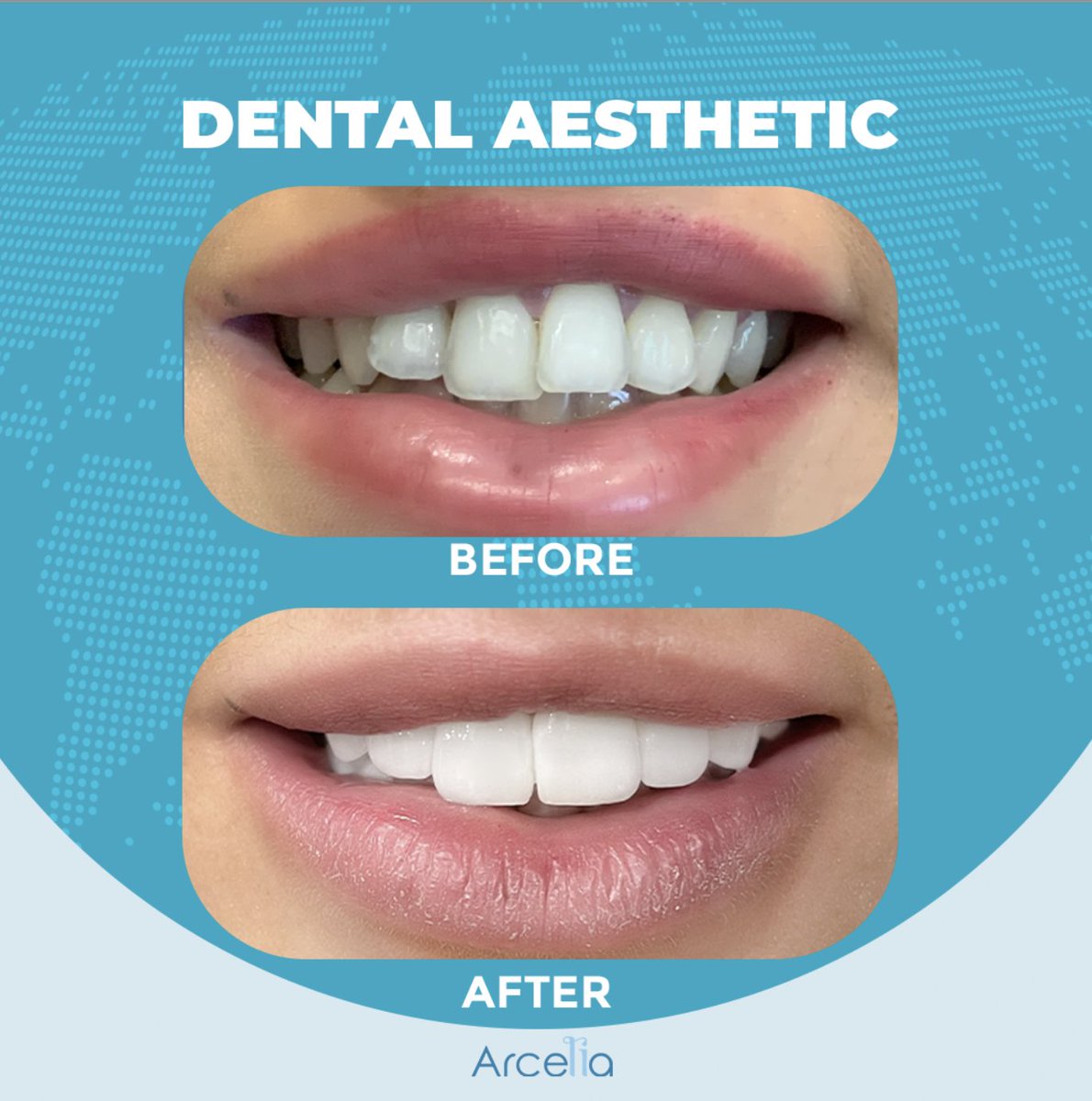 A smile that you deserve😊

#dentalaesthetic #plasticsurgery #dentalcare