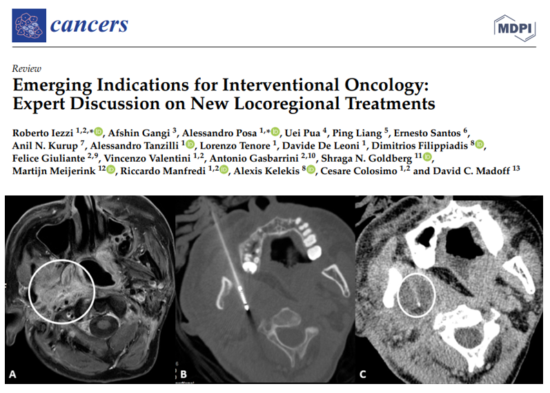 Hot off the press in Cancers! Excellent overview of many emerging indications for #InterventionalOncology. Locoregional therapies for spine & skull base tumors, #breastcancer, head & neck cancer, intrahepatic cholangiocarcinoma & others discussed. #irad mdpi.com/2072-6694/15/1…