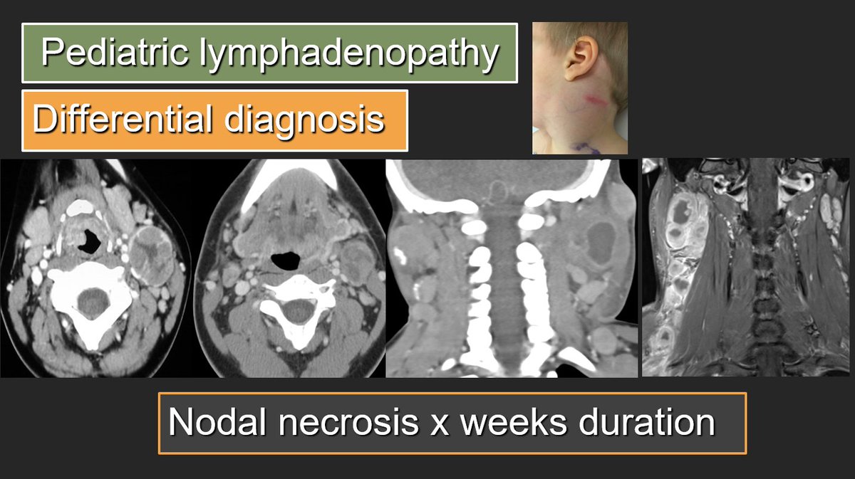 Week 2: What's your differential diagnosis for enlarged necrotic nodes in a child, duration x weeks, unresponsive to conventional antibiotics? #FOAMrad #FOAMed #MedEd #NeuroRad