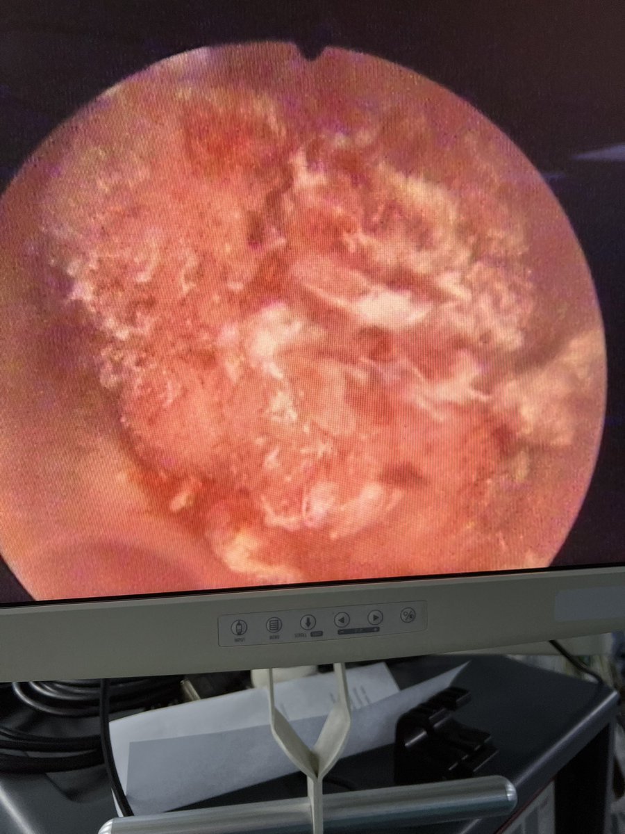 adeelanwaar3's tweet photo. Crystal Clear post op irrigat. after #Diode_Laser Ablation of multiple bladder Growths larg.(5 x 4cm)we always work on bladder preservation techniques @drkemalsarica @mohamed92902484 @Mohamedendourol @DrPNMaheshwari @mohamed92902484 @CleClinicUro @sajjadtmg1 @Uro_News @so_uro https://t.co/blyCCZB6Oy