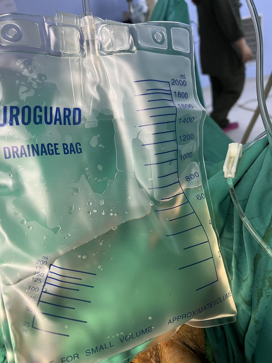 adeelanwaar3's tweet photo. Crystal Clear post op irrigat. after #Diode_Laser Ablation of multiple bladder Growths larg.(5 x 4cm)we always work on bladder preservation techniques @drkemalsarica @mohamed92902484 @Mohamedendourol @DrPNMaheshwari @mohamed92902484 @CleClinicUro @sajjadtmg1 @Uro_News @so_uro https://t.co/blyCCZB6Oy