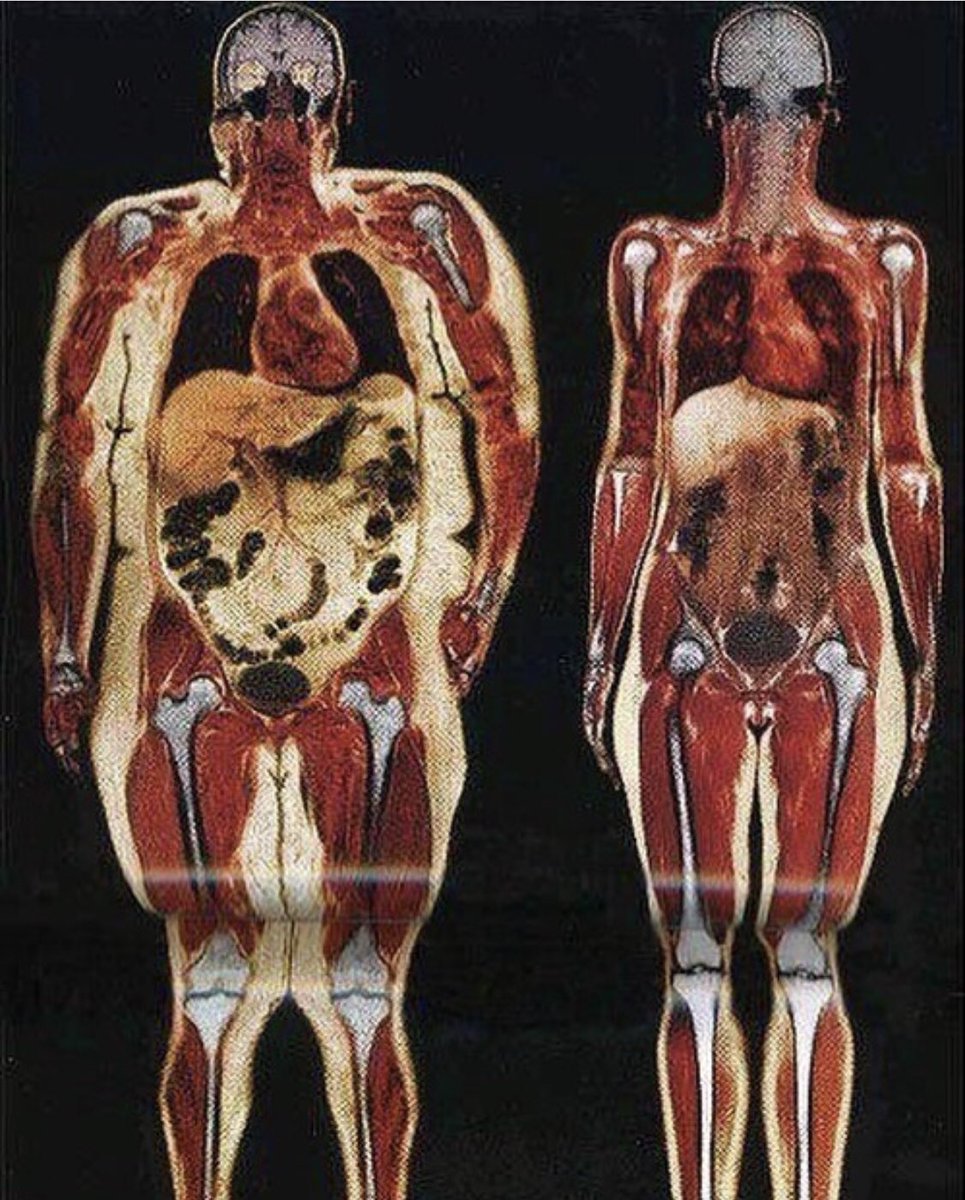 الجسم : الصحي vs المُصاب بالسمنة !