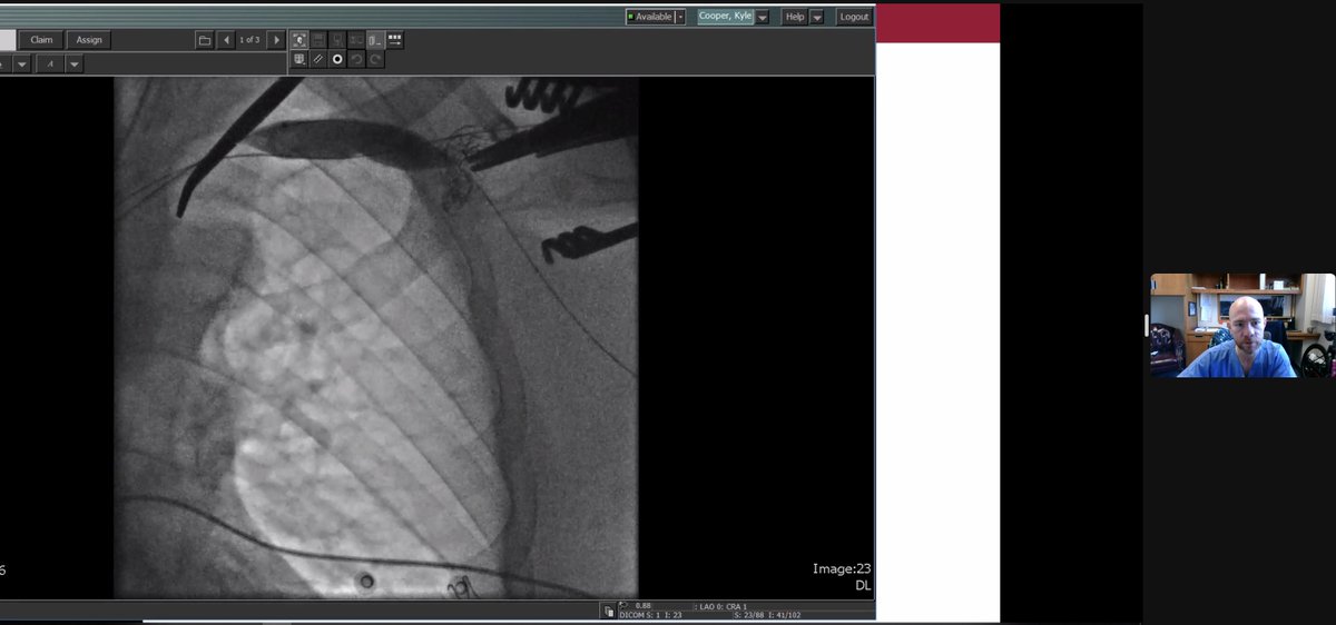 Great Symposium thus far! Lots of neat clinical pearls and great advice on the path to VIR/VIR subspecialities. <a href="/SIRRFS/">SIR RFS</a> 
#SIRVIRIGMS