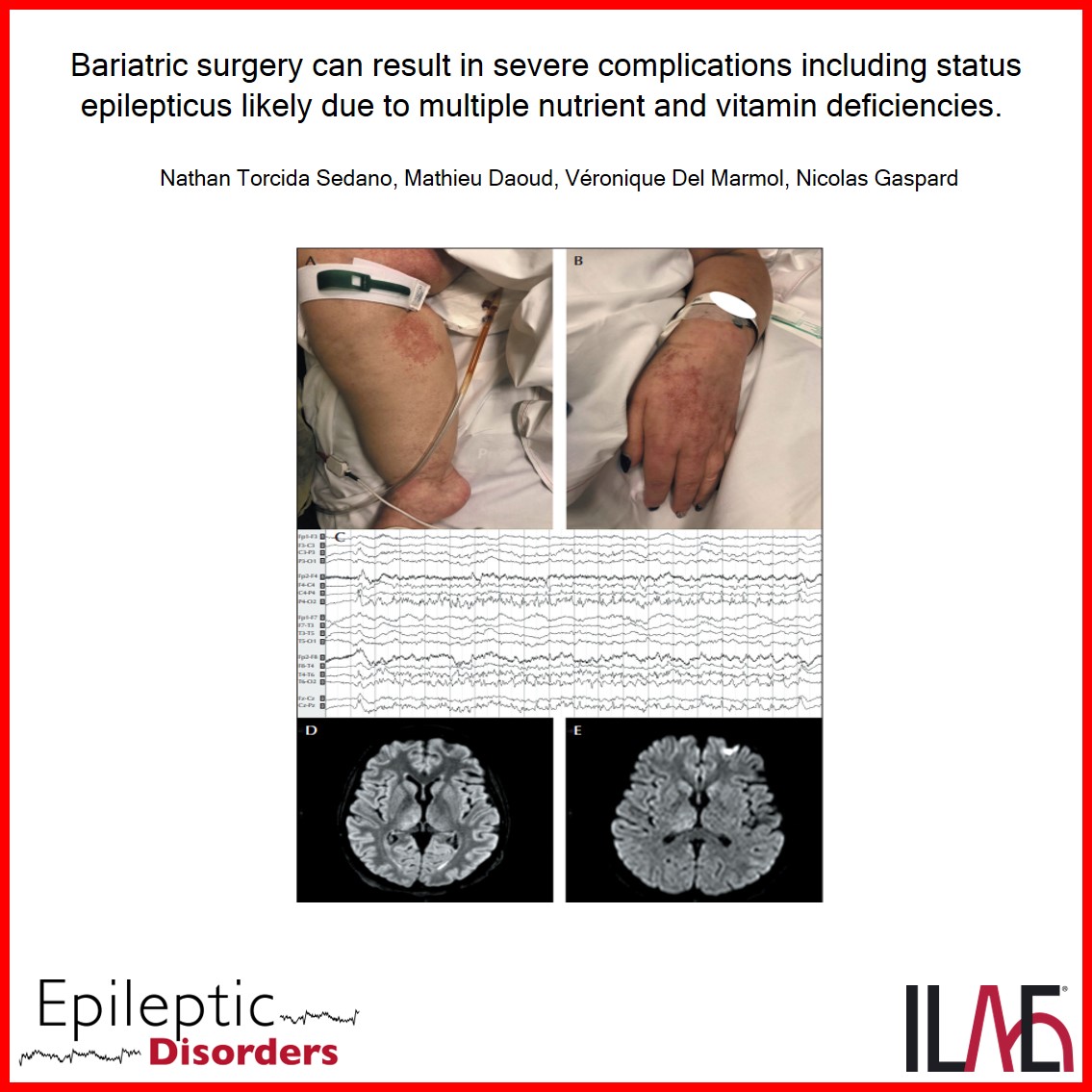 EpiDisorders's tweet photo. (1/2) Sedano et al. report a 39 yo F with status epilepticus/SE six months after gastric bypass surgery in the setting of lack of post-operative nutritional follow-up or adherence to vitamin supplementation. https://t.co/iD8rq3u7TC https://t.co/lsDTsCBga8