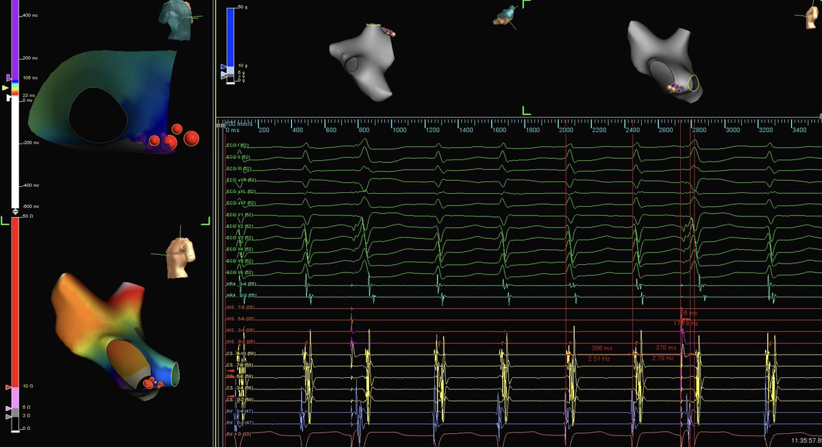 forkknifecab_EP's tweet photo. This PHC (Premature HIS Bundle Complex) described by @PadanilamBenzy et al @CirculationEP, measured 58 msec early to HIS potential, perturbed A-A by “JUST” 18 msec, #AVNRT. A clever maneuver with 100% Sens / Spec. #PDXMapping by @JaylynnMariePDX @Ashit_EPS https://t.co/6YtoScq6yl https://t.co/UAK2nqqTht