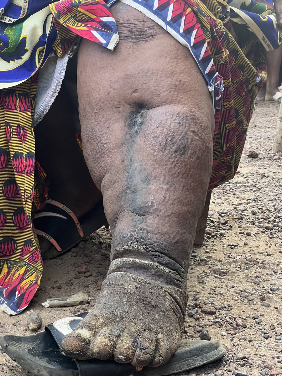 #SierraLeone is said to be on the verge of eliminating elephantiasis. Transmission remains in only 1 of the country’s 16 districts. Ahead of NTDs Day on 30/1/23, I went to find out about the life of those living with the disease & why it persists in Bombali District. @BBCAfrica