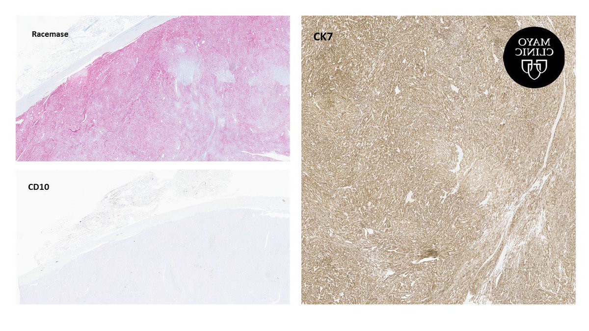 MayoPathology's tweet photo. ⚠️Renal mass⚠️, middle-aged woman 👩 https://t.co/ueB90shPWW @theglasspusher @rajalbshah @FridaRosenblum @kis_lorand @MayoClinicPath @johncheville @ZhaiJim @selveras_stains @Williamson_SR @Shounak_Gupta @KMirza @bonnie_choy @AMubeen_Path #GuPath #patht #pathology @AzizaNassar2 https://t.co/xgmqqkzhdx